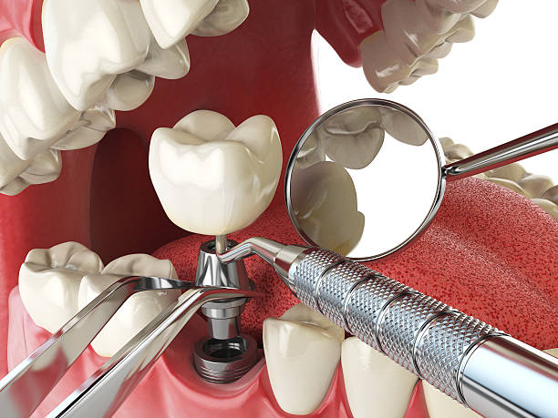 Best Emergency Dentist for Lost Fillings or Crowns in Crystal Lake, FL